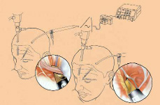 神經科手術圖片